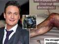 Gary Lucy shocks fans with gruesome pic of his knee injury after car crash