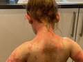 Mum warns of Strep A 'sunburn skin' symptom after her child's 'head-to-toe rash'