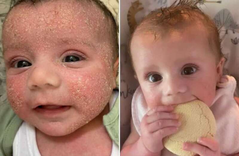 Parents rave over 'miracle' treatment that clears up baby's agonising eczema