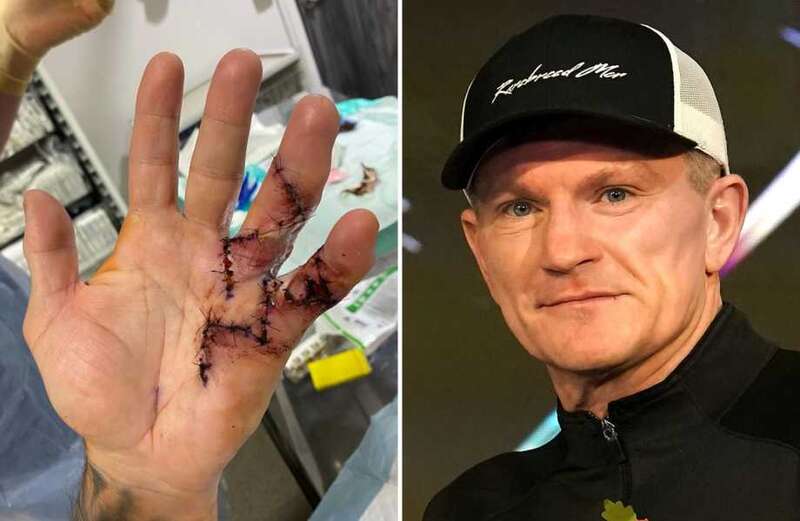 Ricky Hatton undergoes serious operation on hand after contracting rare disease