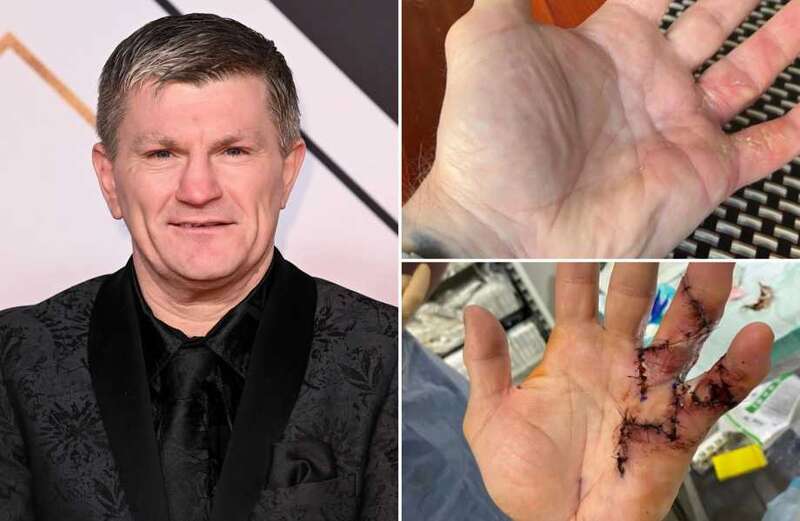 What is Dupuytren’s disease that affects boxer Ricky Hatton?