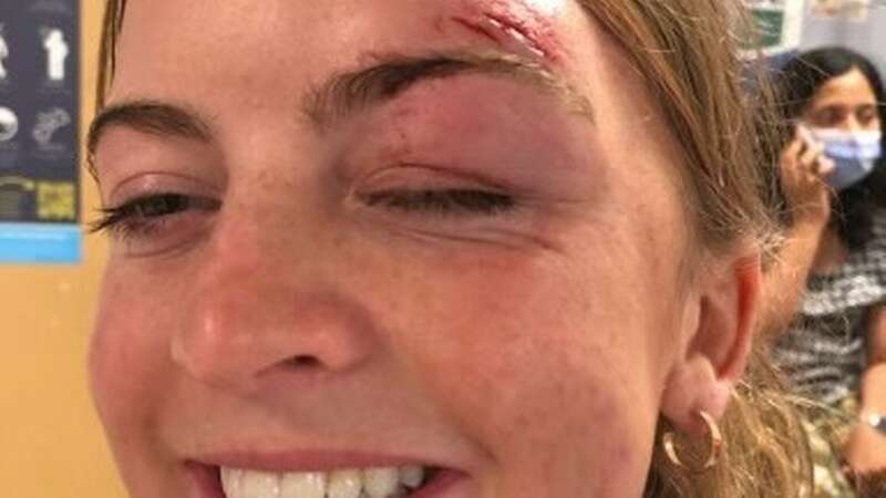 Bride hit with baseball days before wedding walks down aisle with black eye