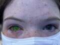 Insect blamed for mystery rise in life-changing illness that alters eye colour eiqrtiqttirtprw