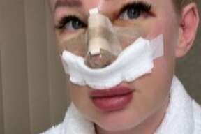 Mafs star shows off swollen & bloody face after surprise nose job