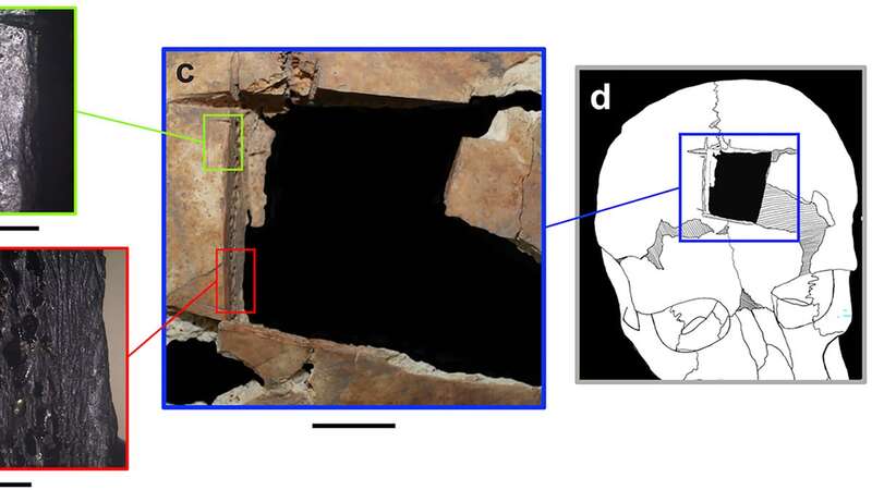 A small square was surgically cut out of a skull in the 15th century (Image: PA)