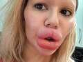 I have world’s biggest lips but I want MORE fillers… my fans fear they’ll burst