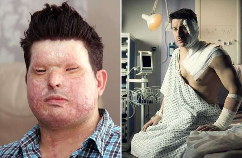 I'm a real life acid attack survivor like Corrie's Ryan Connor - some don’t like the scenes but we can't ignore attacks