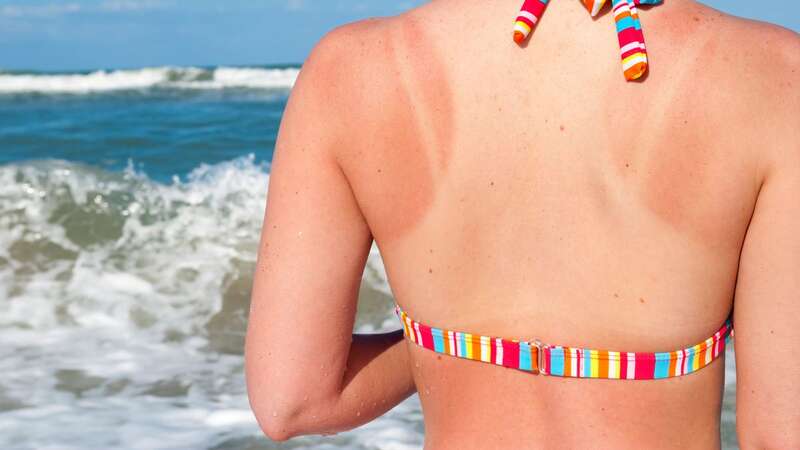 Soaking up the sunshine could lead to sun poisoning (Image: Getty Images)