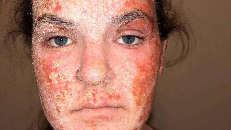 Eczema-sufferer left bed-ridden after reaction to cream made her skin peel off