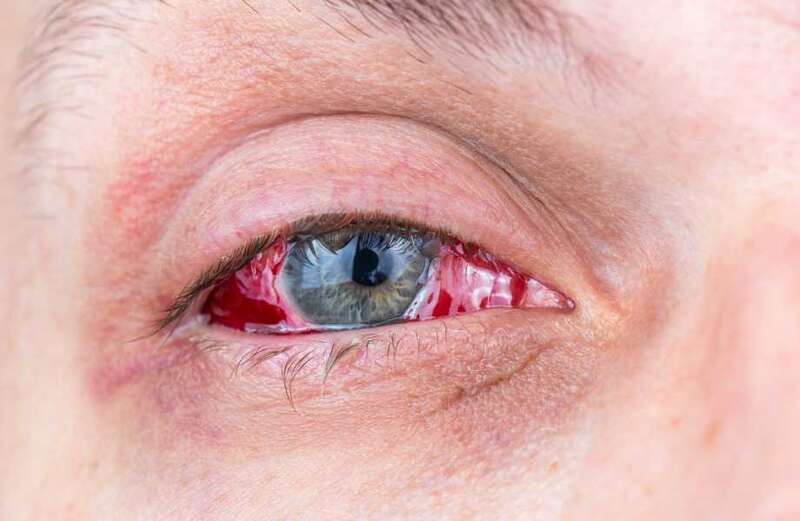 Man dies of horrific eye-bleeding disease sparking fears of outbreak