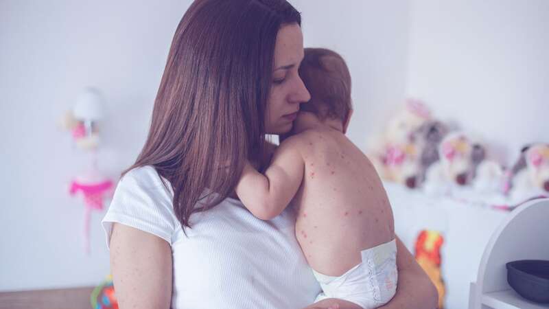 Childhood vaccination rates against measles, mumps and rubella has dropped to just 85.5 per cent (Image: Getty Images)