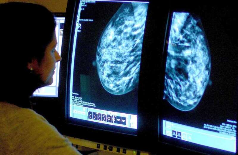 Scientists develop 'life-saving' AI that predicts if breast cancer will spread