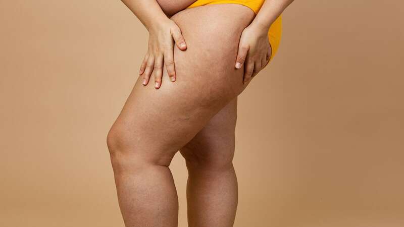 Chafing is one of the down sides of summer, but one woman has suggested a solution (Image: Getty Images/iStockphoto)