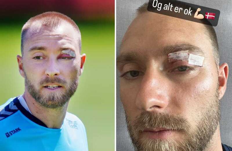 Man Utd star Eriksen shows off gruesome black eye after needing stitches