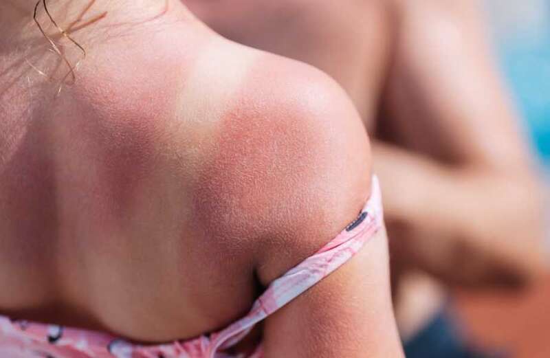 I'm a dermatologist - here's how a common kitchen ingredient can soothe sunburn