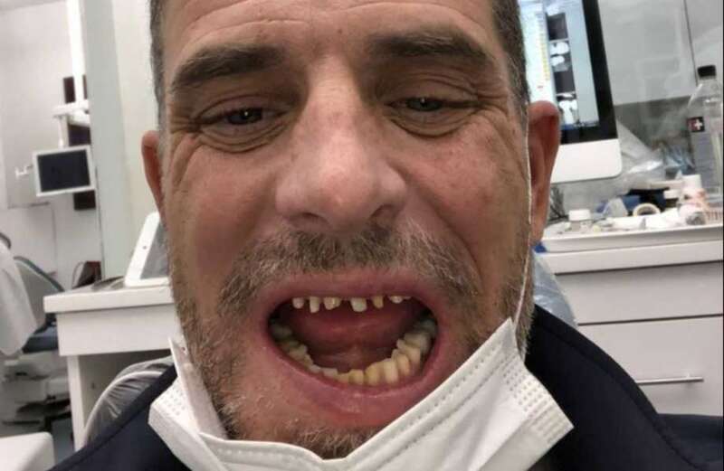 What happened to Hunter Biden's teeth?