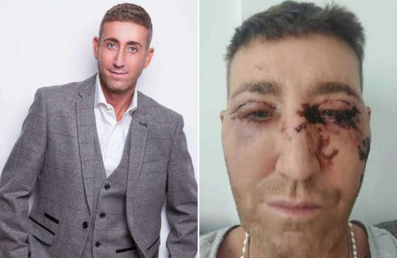 X Factor's Christopher Maloney sparks concern after sharing bloody surgery pics