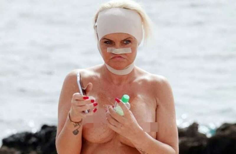 Danniella Westbrook sunbathes topless with bandaged head after hospital incident