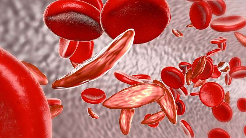 Round, normal red blood cells, and the crescent-shaped cells affected by sickle cell anaemia (Image: Getty Images/Science Photo Library RF)