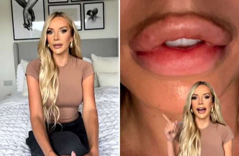 Love Island’s Faye Winter admits she ‘ruined’ her face discussing her old lips