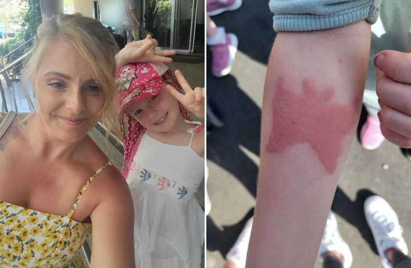 Mum’s warning after girl suffers ‘oozing’ chemical burns from henna tattoo