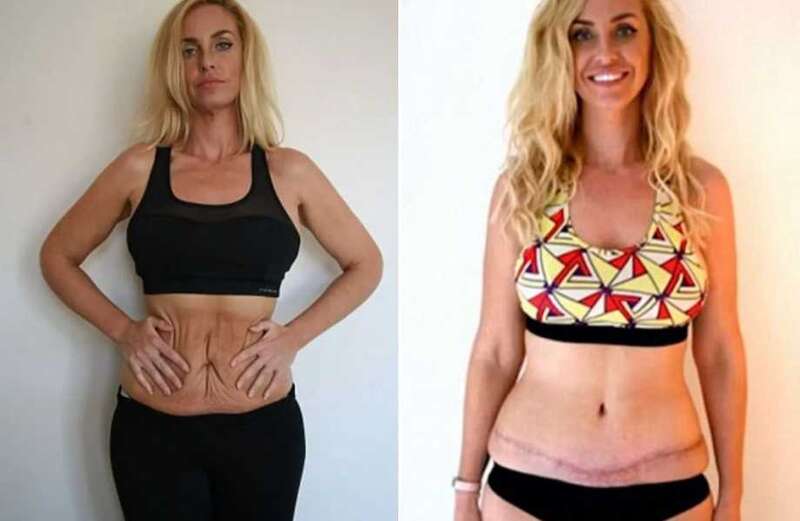 Josie Gibson tummy tuck: Before and after photos