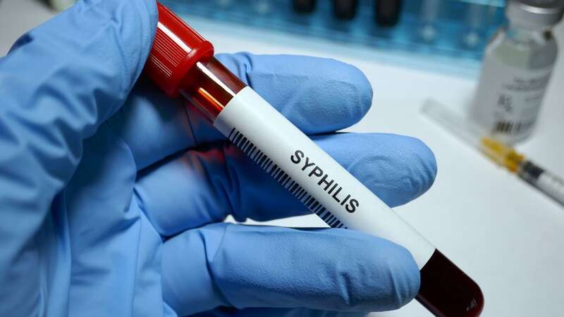 The United States has a syphilis epidemic, and clinics say its a 