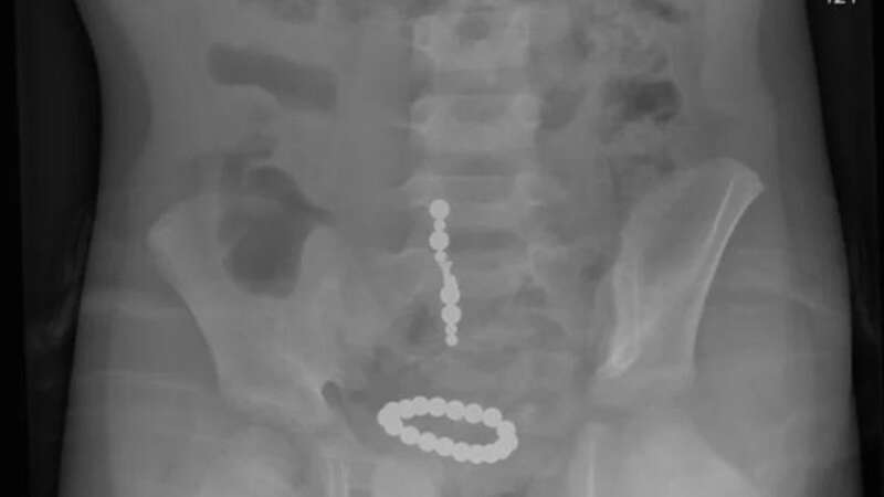 A young girl had to go to hospital after she swallowed magnets (Image: MEN MEDIA)