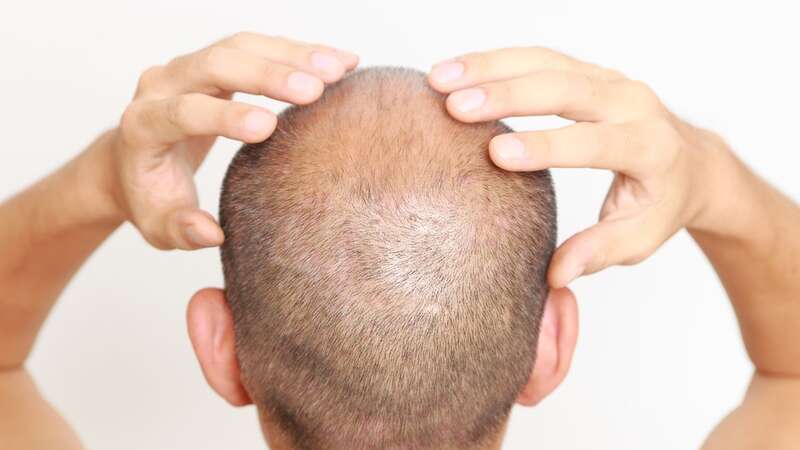 The common grocery could double up as a hair loss prevention hack (Image: Getty Images/iStockphoto)