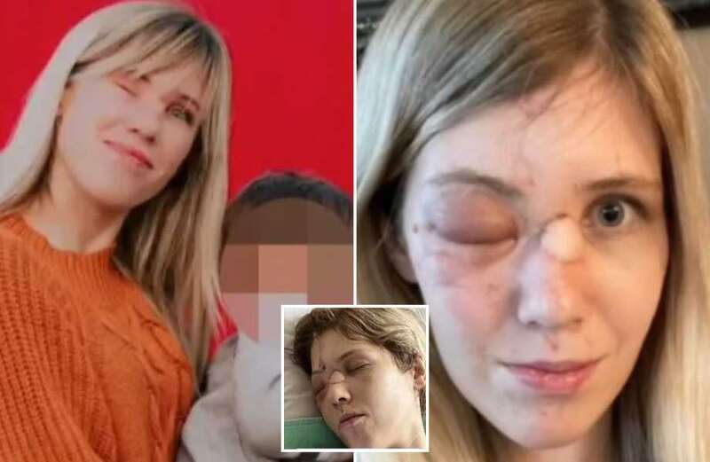 The woman was left needing several surgeries and lost her right eye