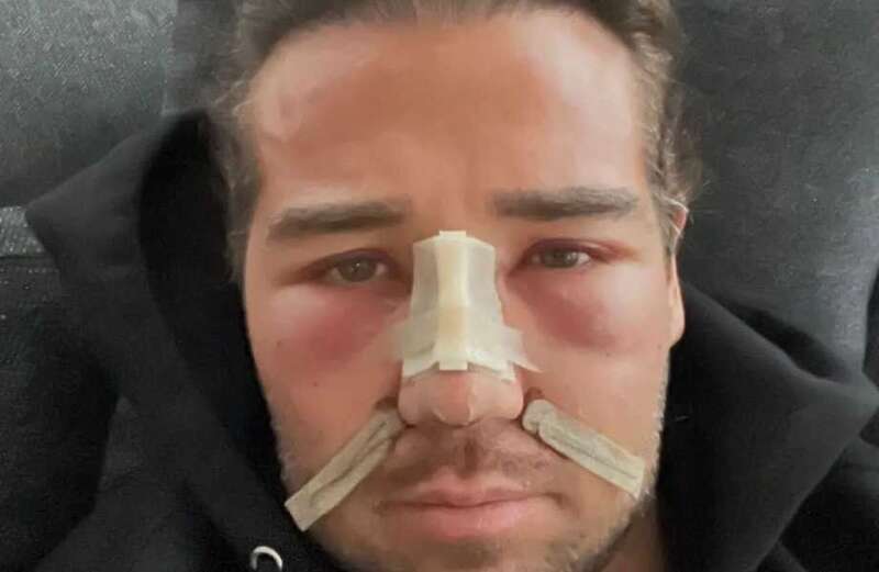 He suffered shocking injuries filming a TV show with another Towie alum