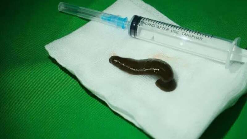 Hospital medics were left stunned when they found the blood sucking leech feeding on a man