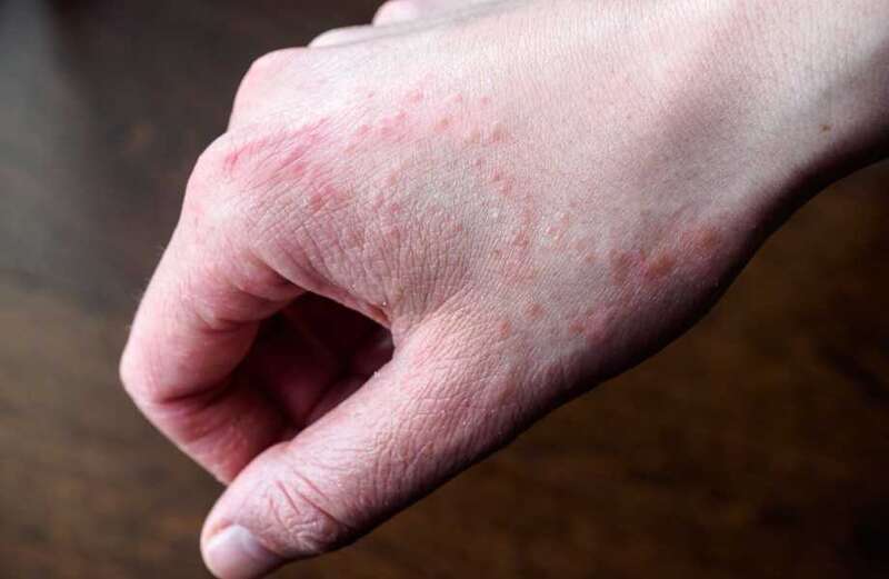 Can you spot the rashes that could be deadly? From cancer to meningitis