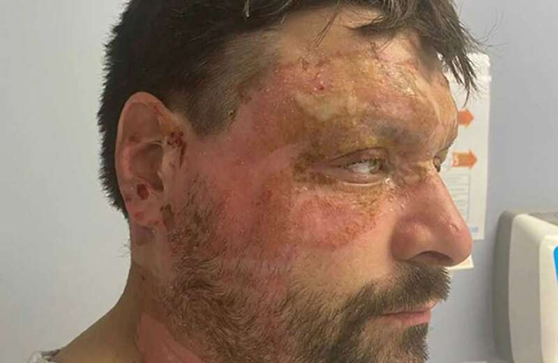 Carl Lowery revealed how he was burned at work