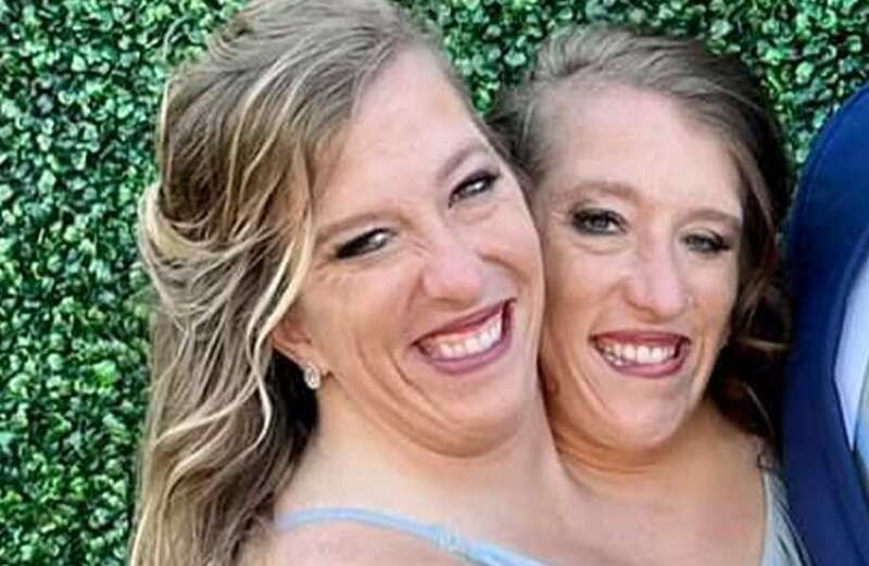 Plus, a video about the story of conjoined twiners who were 