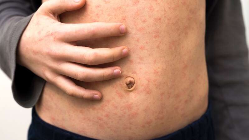 A sick child with red rash from measles. (Image: Getty Images)