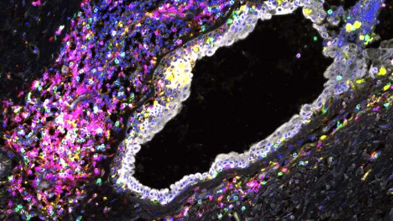 Immune cell exhaustion is observed in breast tissue from carriers of mutations long before breast cancer develops (Image: Sara Pensa/University of Cambridge/SWNS)