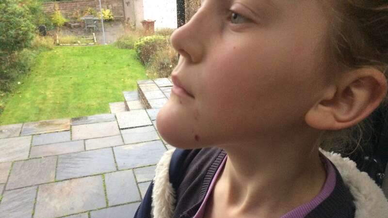 Emily’s chin elongated due to her abscess (Image: Jam Press)