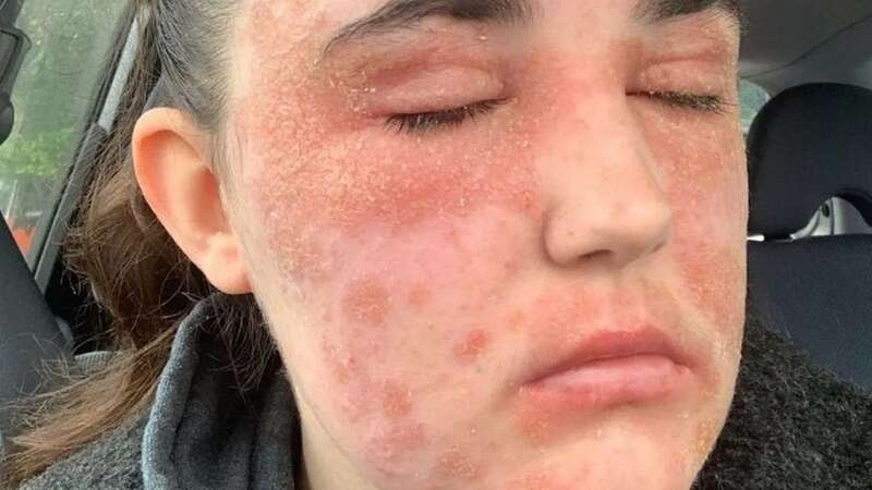 Megan Jones said her eczema turned her into a recluse (Image: PA REAL LIFE)