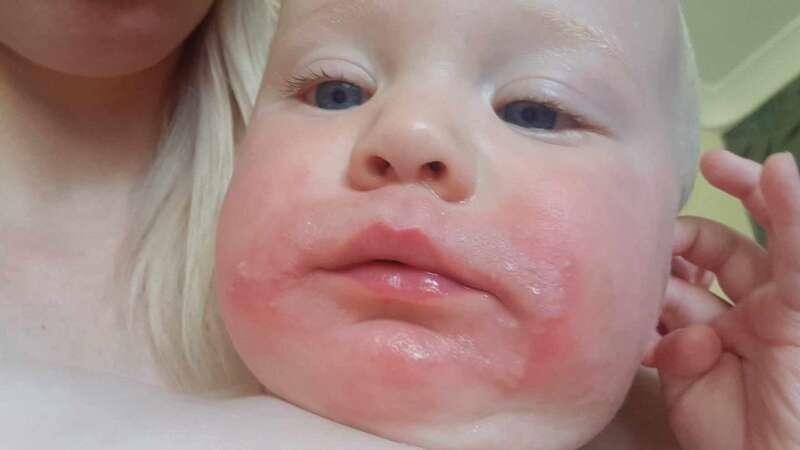 Little two-year-old Kayvon Wright first developed red spots on his face and hands (Image: Credit: Pen News/Samantha Morgan)