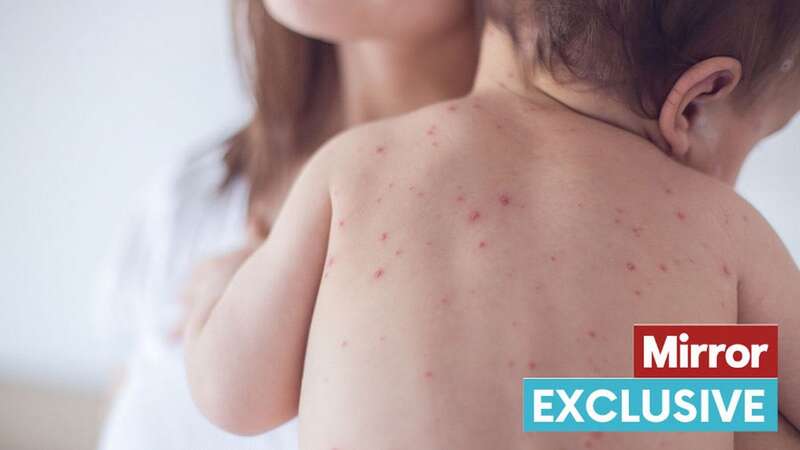 The UK faces the biggest outbreak of the measles virus since 2012 (Image: Getty Images/iStockphoto)