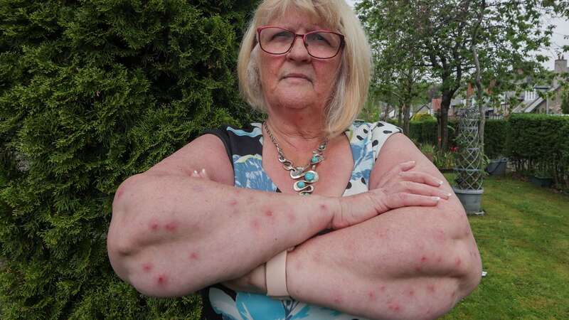 Marjorie McCance was left with dozens of infected sore during her holiday to Cape Verde (Image: Glasgow Times / SWNS)