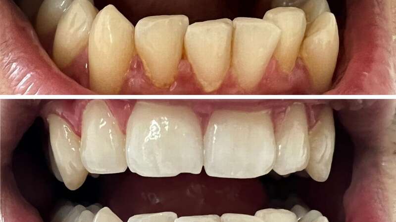 One customer before and after using My Sweet Smile teeth whitening powder (Image: MySweetSmile)