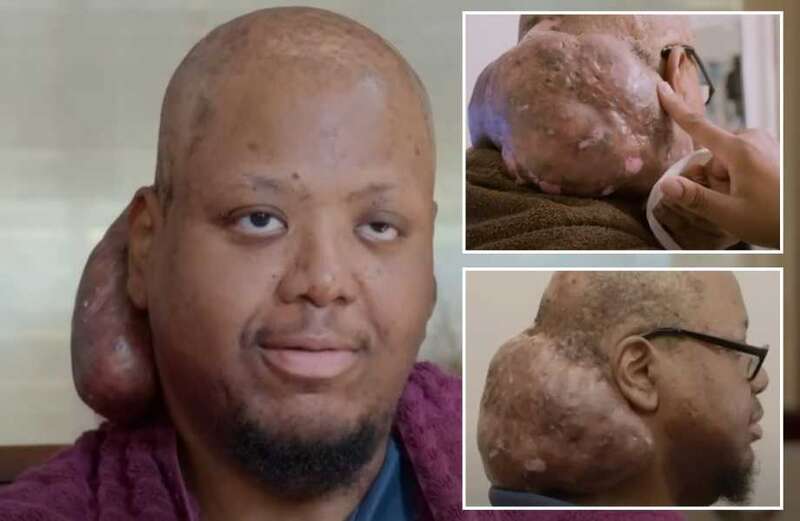 The 33-year-old hid himself away for over a decade after he was mercilessly teased at school for the foul-smelling growth on the back of his head