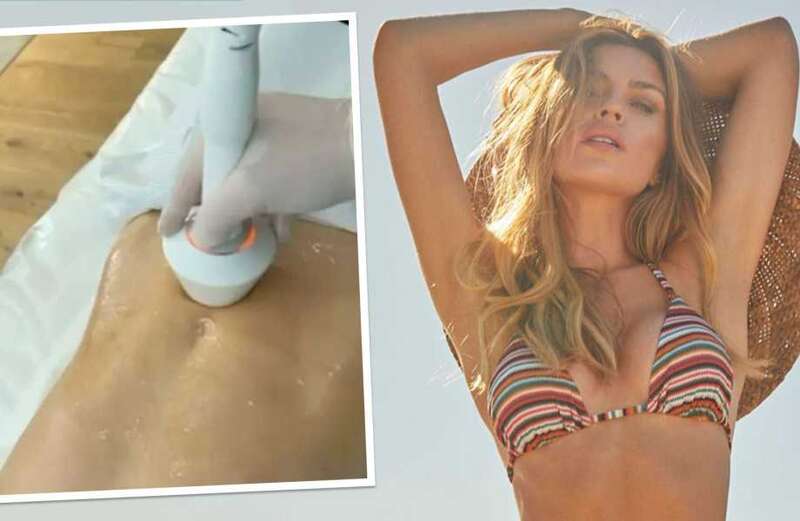 Watch the above clip to see Abbey Clancy having the pricey tightening treatment on her arms