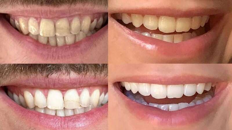 The before and after results of shoppers trying MySweetSmile