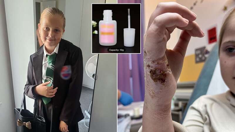 One family claimed their little girl suffered burns after using a nail glue from Temu (Image: Kennedy News & Media)