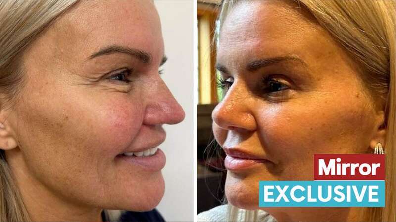 Kerry Katona showcases incredible results of nose job after drug damage