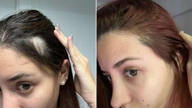 Hairline and thickness before and after using the UKLash Growth Serum (Image: UKLASH)