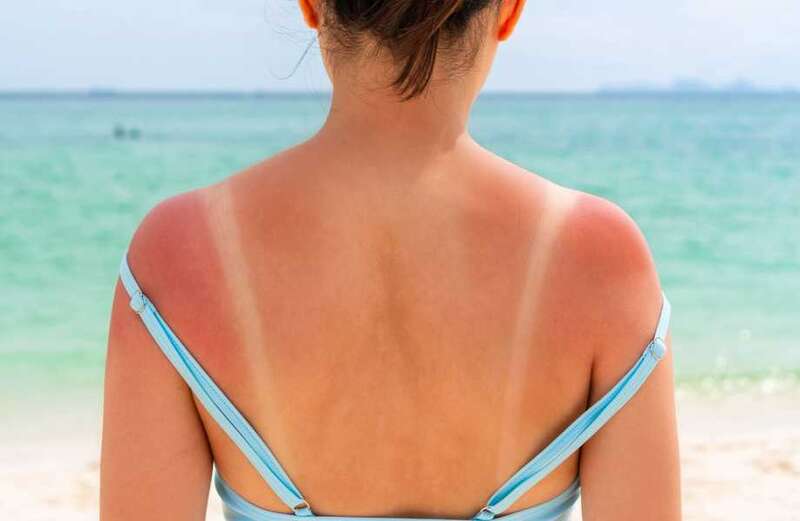 Others shared their own home remedies for curing sunburns